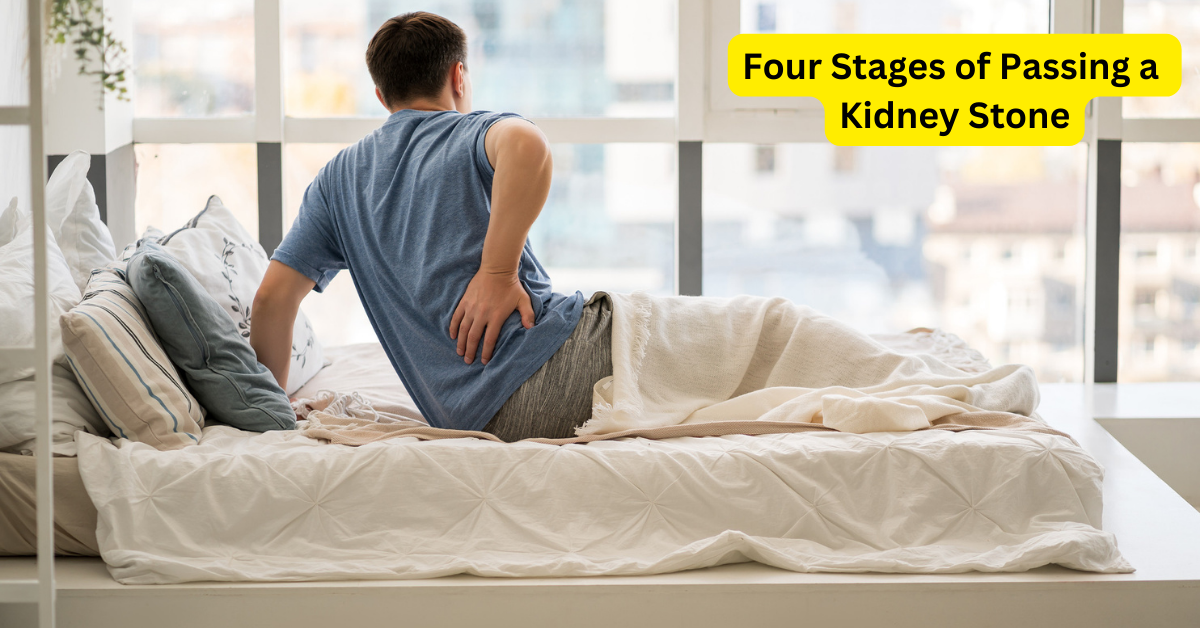 Four Stages of Passing a Kidney Stone